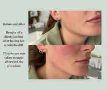 Load image into Gallery viewer, 8 Point Facelift